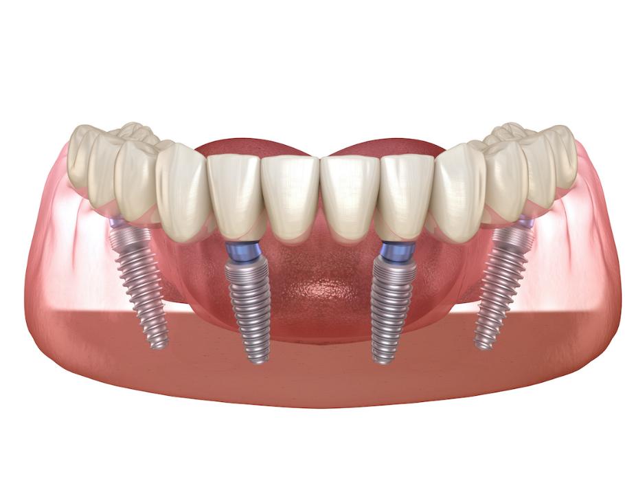 all on 4 dental implants surf city