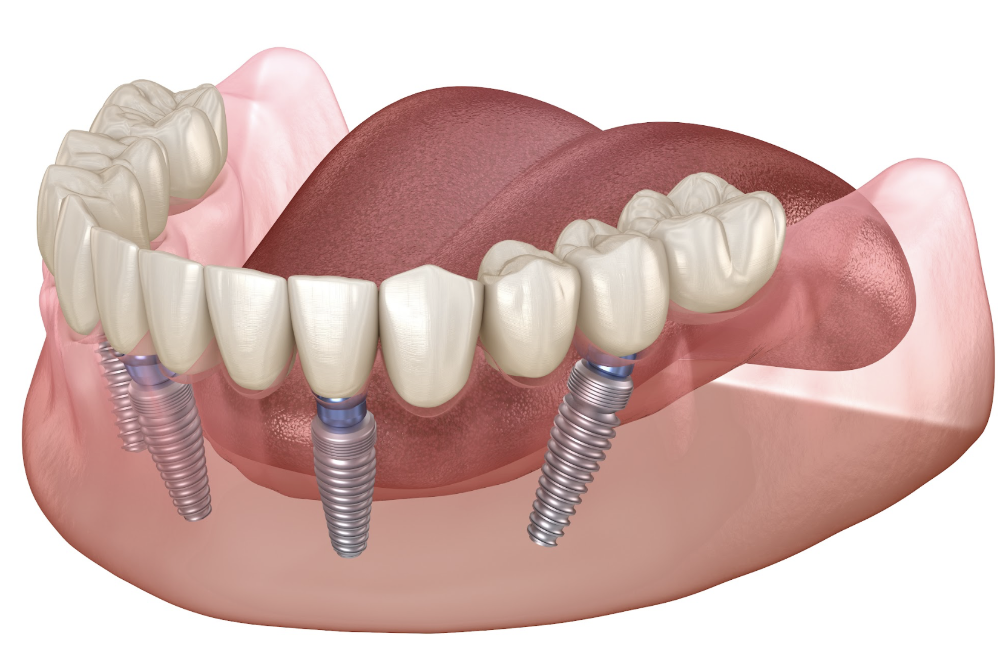 all on 4 dental implants surf city