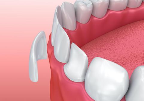 dental veneers surf city