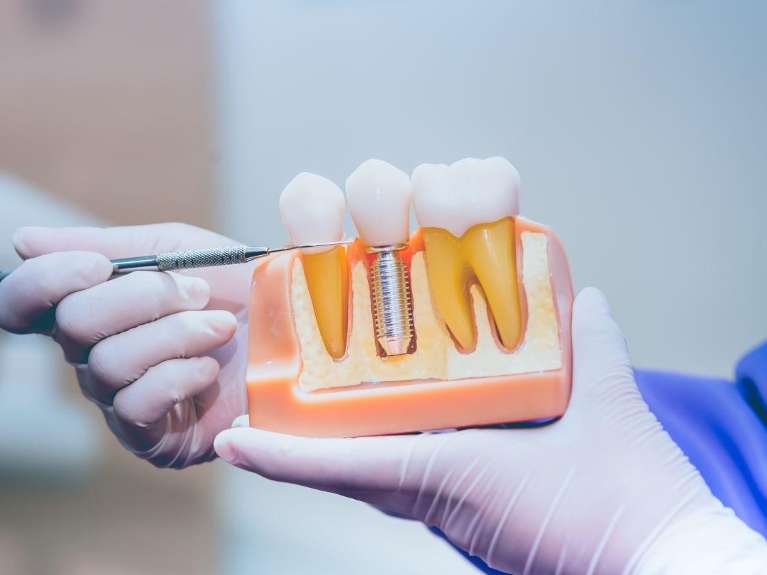 all on 4 dental implants surf city | model of dental implant