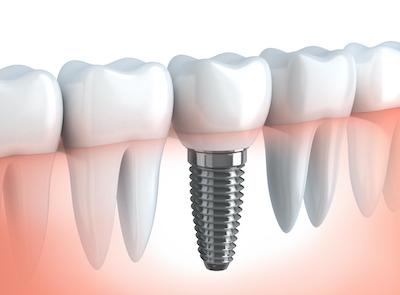 dental implants surf city