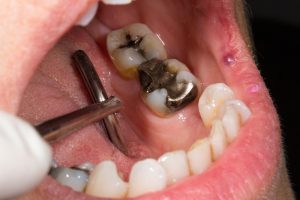 silver amalgam dental fillings