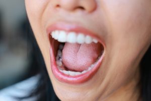 woman open mouth with cavities
