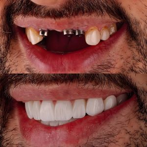 Before and after image of a dental restoration, showcasing a patient's smile transformation with missing teeth replaced by natural-looking dental implants and crowns, highlighting restorative dentistry benefits.