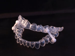 Custom oral appliance for sleep apnea treatment, designed to reposition the jaw and maintain an open airway during sleep.