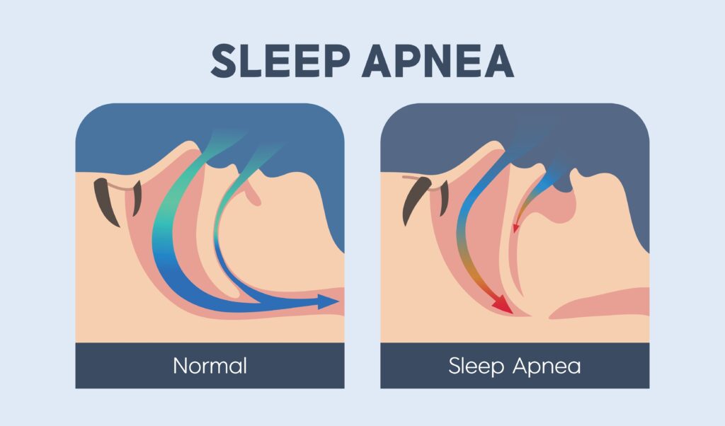 Illustration comparing normal airflow and obstructive sleep apnea, highlighting airway blockage and breathing patterns, relevant to sleep apnea treatment information.