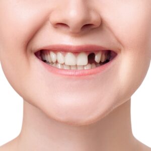 smile with missing tooth